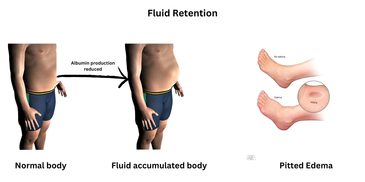  Fluid Retention