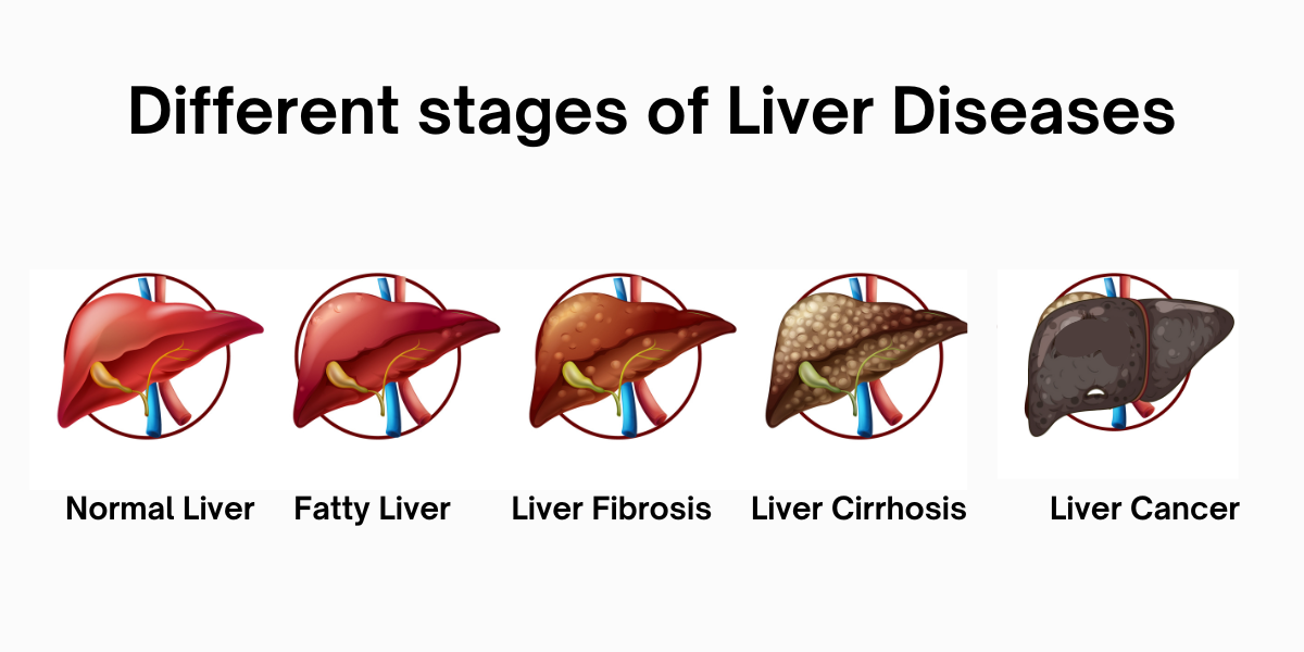 Different stages of liver diseases